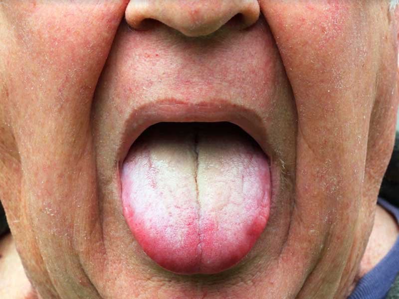 White Tongue Causes 11 Natural Remedies To Make It Healthier Origin 