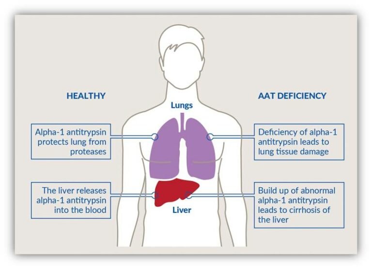 Your Guide To Alpha-1 Antitrypsin (AAT) Deficiency - Origin Of Idea